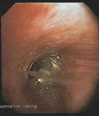 This image, taken during the bronchoscopy, shows the earring lodged in the woman's right bronchus.