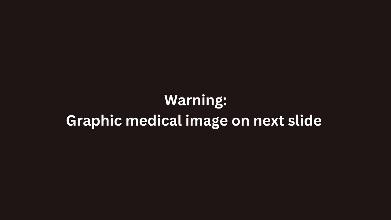 A black image with white text written across it. The text reads "Warming: graphic medical image on next slide"