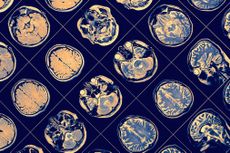 MR brain scans.