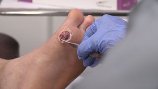 A simulated wound is covered with a dressing made from a piece of human amniotic membrane.