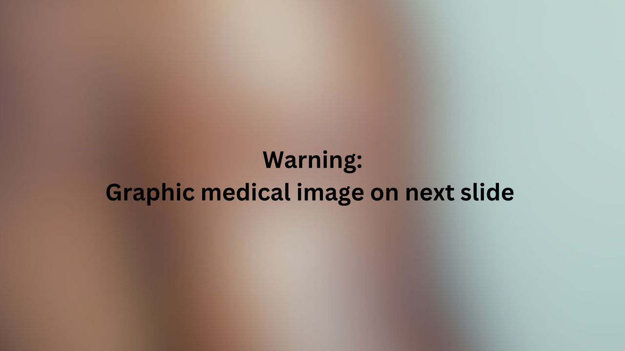A blurred image with black text written on top. The text reads: "Warning: graphic medical image on next slide"