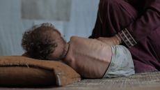 Three-year-old Palestinian child Edhem Mohammed Abu Urmana, who was forced to flee his home with his family due to Israel's ongoing attacks and blockade, struggles to survive in a tent in the Nuseirat refugee camp in Gaza on August 8, 2025.