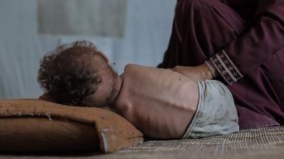 Three-year-old Palestinian child Edhem Mohammed Abu Urmana, who was forced to flee his home with his family due to Israel's ongoing attacks and blockade, struggles to survive in a tent in the Nuseirat refugee camp in Gaza on August 8, 2025.