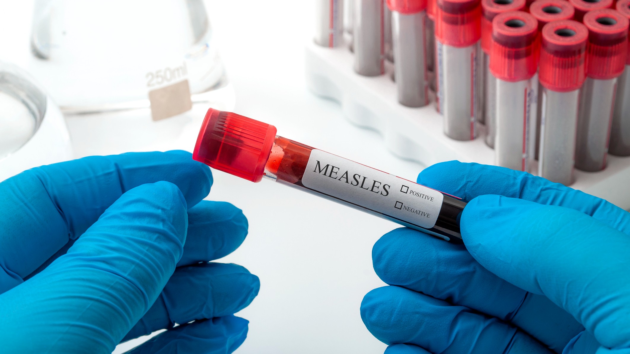 2nd measles death reported in US outbreak was in New Mexico adult