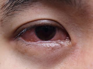 A close-up of an inflamed, red eye.