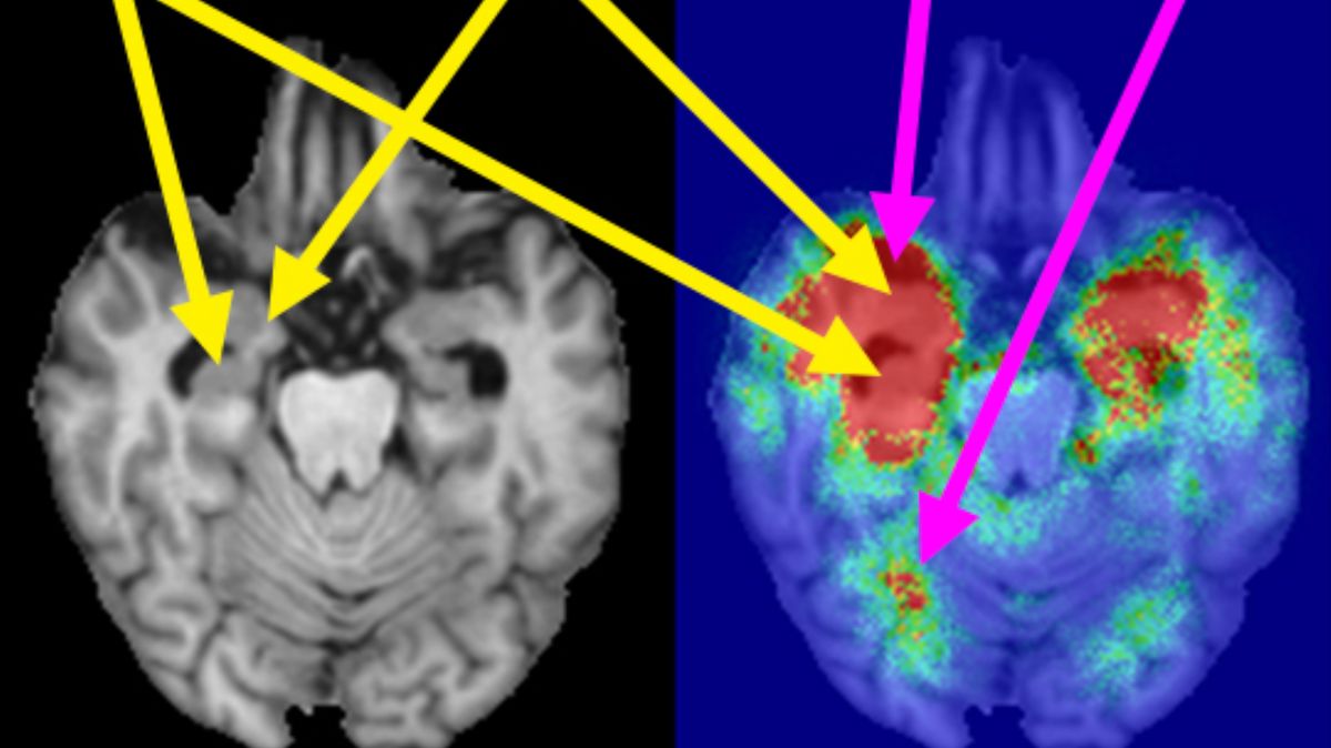 AI technology used to predict Alzheimer&#039;s