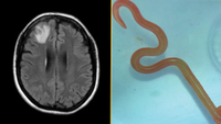 (left) Magnetic resonance image of patient&rsquo;s brain by fluid-attenuated inversion recovery demonstrating an enhancing right frontal lobe lesion, 13 \00d7 10 mm. (right) Live third-stage larval form of O. robertsi (80 mm long, 1 mm diameter) under stereomicroscope (original magnification \00d710).