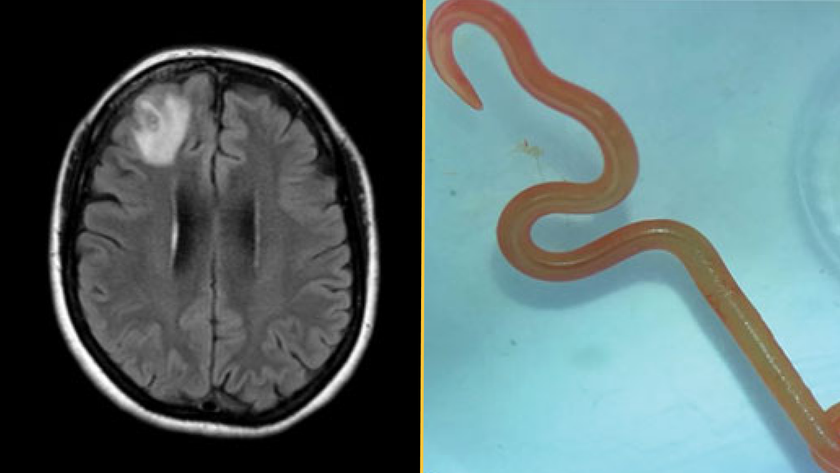 (left) Magnetic resonance image of patient&rsquo;s brain by fluid-attenuated inversion recovery demonstrating an enhancing right frontal lobe lesion, 13 &times; 10 mm. (right) Live third-stage larval form of O. robertsi (80 mm long, 1 mm diameter) under stereomicroscope (original magnification &times;10).