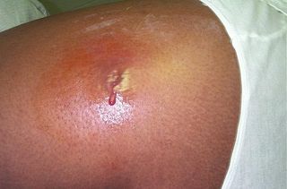 This 2005 photograph shows an abscess on a person's hip, which had begun to spontaneously drain, releasing its contents. The abscess was caused by methicillin-resistant Staphylococcus aureus (MRSA) bacteria.