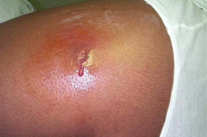 This 2005 photograph shows an abscess on a person&#039;s hip, which had begun to spontaneously drain, releasing its contents. The abscess was caused by methicillin-resistant Staphylococcus aureus (MRSA) bacteria.