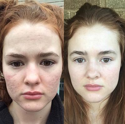 The Best Accutane Before-and-After Results - Kali Kushner of ...