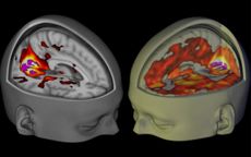 The effect of LSD on the brain