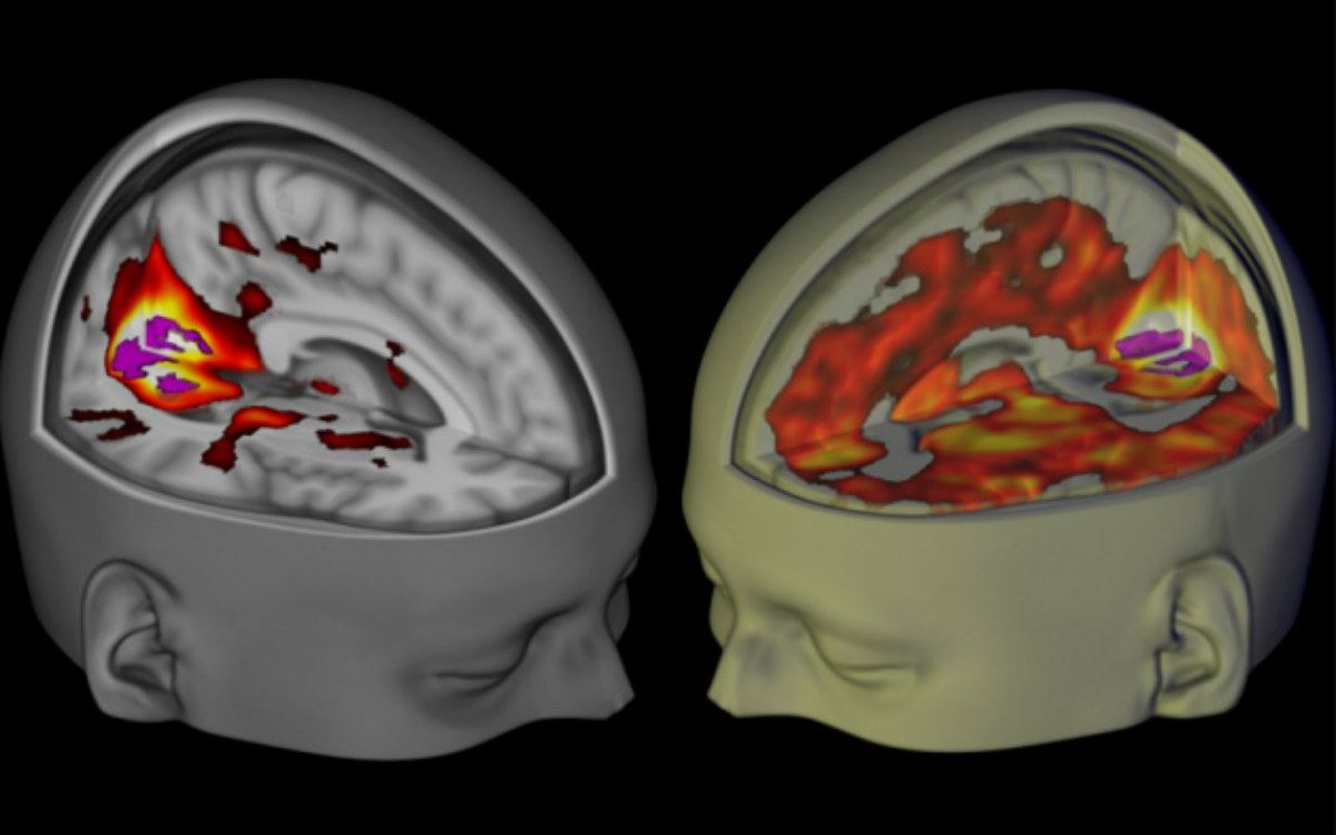 The effect of LSD on the brain