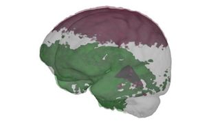 This illustration comes from the cosmonaut brain study performed by Steven Jillings of the University of Antwerp. In September 2020, Jillings and his team published findings that confirm earlier findings about the effect of spaceflight on the distribution of craniospinal fluid around the brain. The lower region of the brain was surrounded by more of this fluid than the top region of the brain. This is likely a sign that spaceflight caused the brain to shift upwards in the skull.