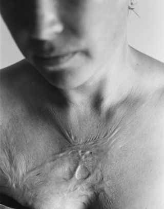 a burn scar on someones chest