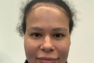 Amerley Ollennu with pre-surgery hairline draw on before her hair transplant surgery