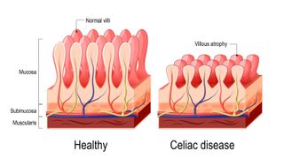 Vector diagram comparing healthy villi side by side with villous atrophy due to celiac disease.