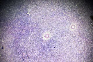 Non-Hodgkin Lymphoma under microscope