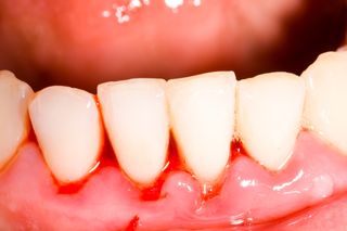 The same teeth as above, after the tartar has been removed during dental treatment.