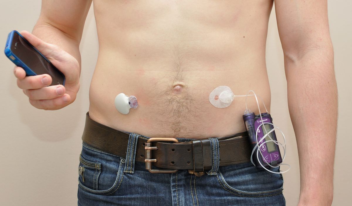 An artificial pancreas 