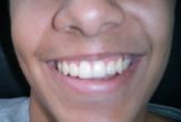 Is UV Light Teeth Whitening Safe?