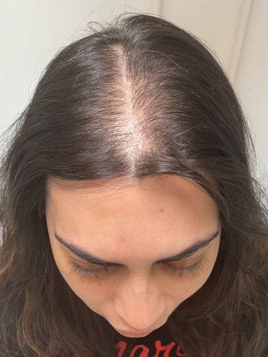 Harklinikken Hair Gain Extract Before and After 