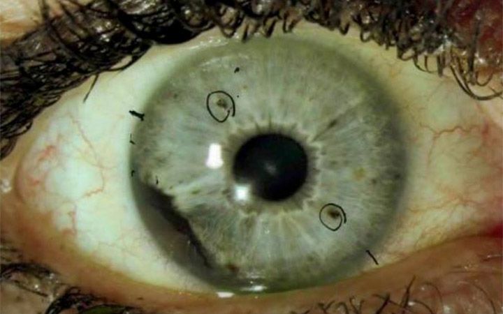 ocular melanoma