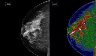 mammogram-both-101014-02