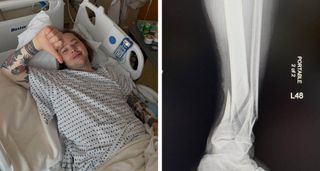 Billy Strings posts a picture from hospital as he recovers from a broken leg.