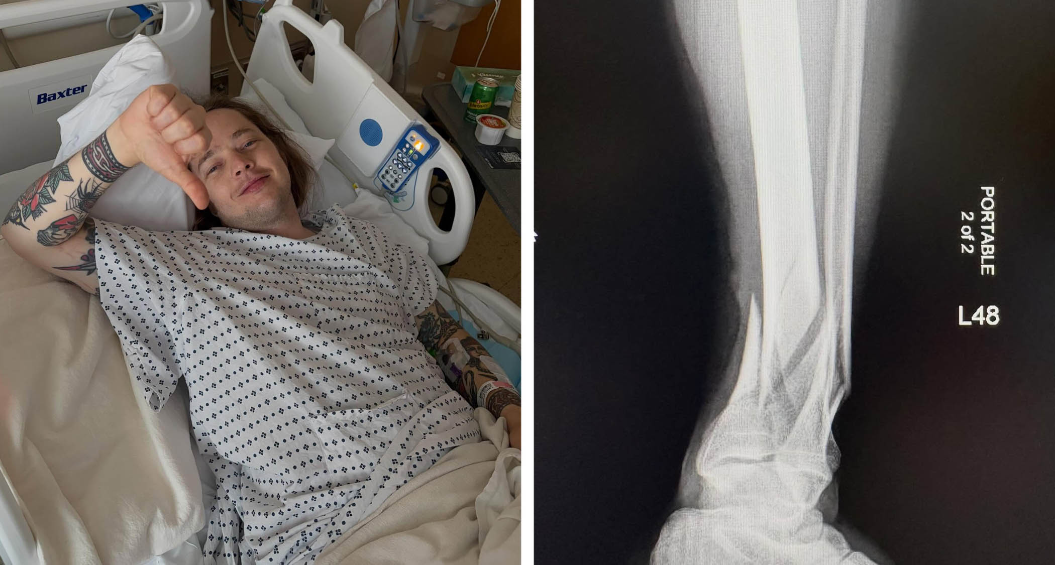 Billy Strings posts a picture from hospital as he recovers from a broken leg.
