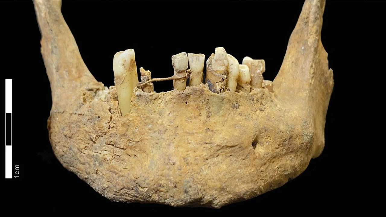 500-year-old gold dental bridge is earliest known oral care of its kind in Scotland — and it likely held a fake tooth