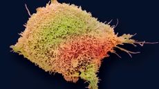 A cervical cancer cell in high-resolution under the microscope. The cell is fluorescently-colored green, red and orange and the background is black.