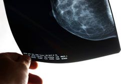 Scientists recently identified two gene variants that may predict which women at high-risk for breast cancer will benefit from drugs to prevent the disease.
