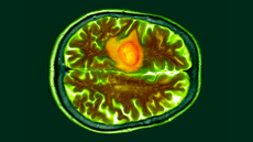Colored CT scan of a section through a person's brain with a glioblastoma shown in orange on the left side of the brain (shown at the top in this image as rotated 90 degrees)