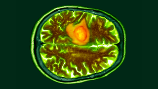 Colored CT scan of a section through a person's brain with a glioblastoma shown in orange on the left side of the brain (shown at the top in this image as rotated 90 degrees)