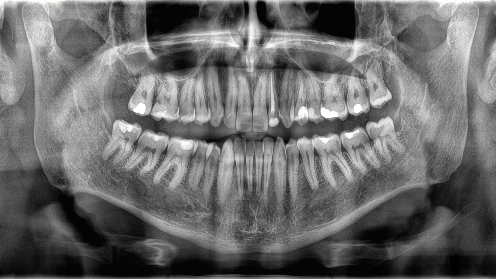 an x-ray of teeth in a human mouth