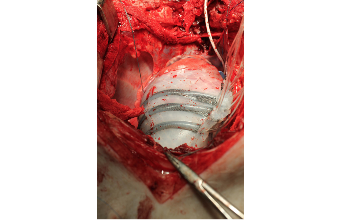 The soft robotic sleeve, shown here implanted on a pig heart, can squeeze the heart to help it pump.