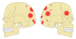A digital illustration showing a compilation of the skull injuries the Neolithic people sustained just before they died.