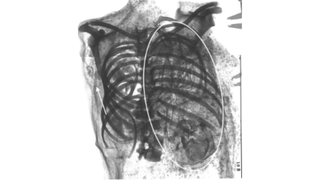 An X-ray scan of the mummy's torso showing the remains of a fetus.