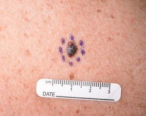 Pictures of cancerous moles: malignant melanoma