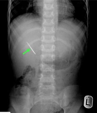 This X-ray of the boy’s abdomen shows two sharp, opaque pieces of a bobby pin in the boy’s body.