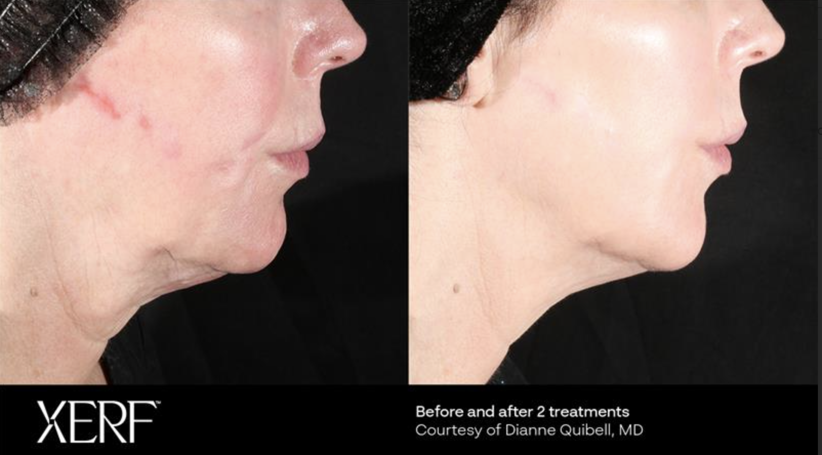 a before and after photo of a woman&#039;s neck