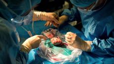 Doctors transplanting a kidney