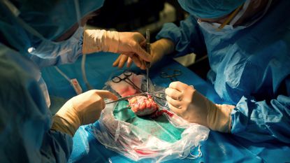 Doctors transplanting a kidney