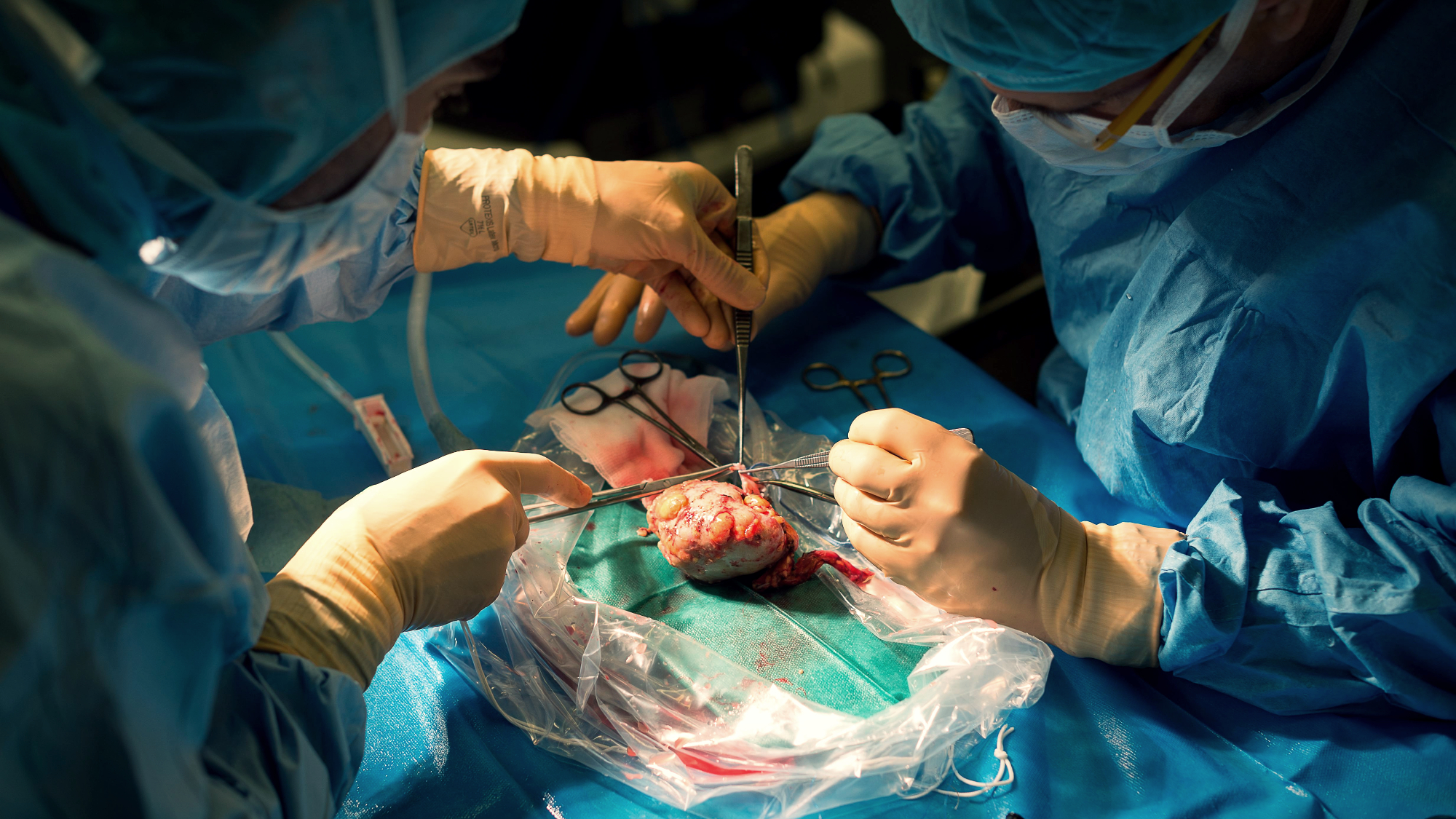  Pig kidney transplant recipient dies 