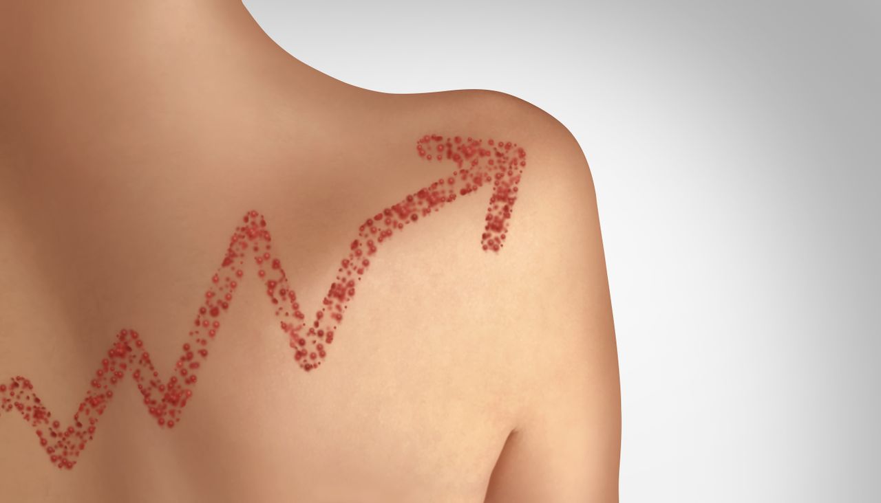 A drawing of a measles rash on an adult&#039;s back in the shape of an arrow trending upward.