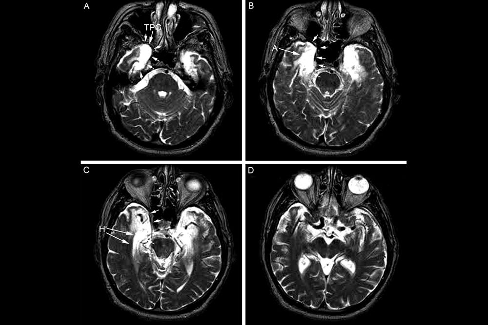 ep&#039;s brain, profound amnesia, brain damage