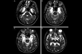 ep's brain, profound amnesia, brain damage