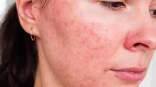 woman with rosacea on her face