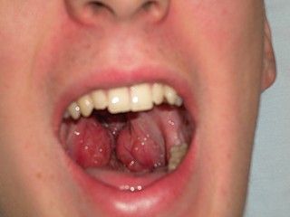 largest tonsils